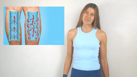 Estrategias sencillas para tratar y prevenir la aparición de venas várices